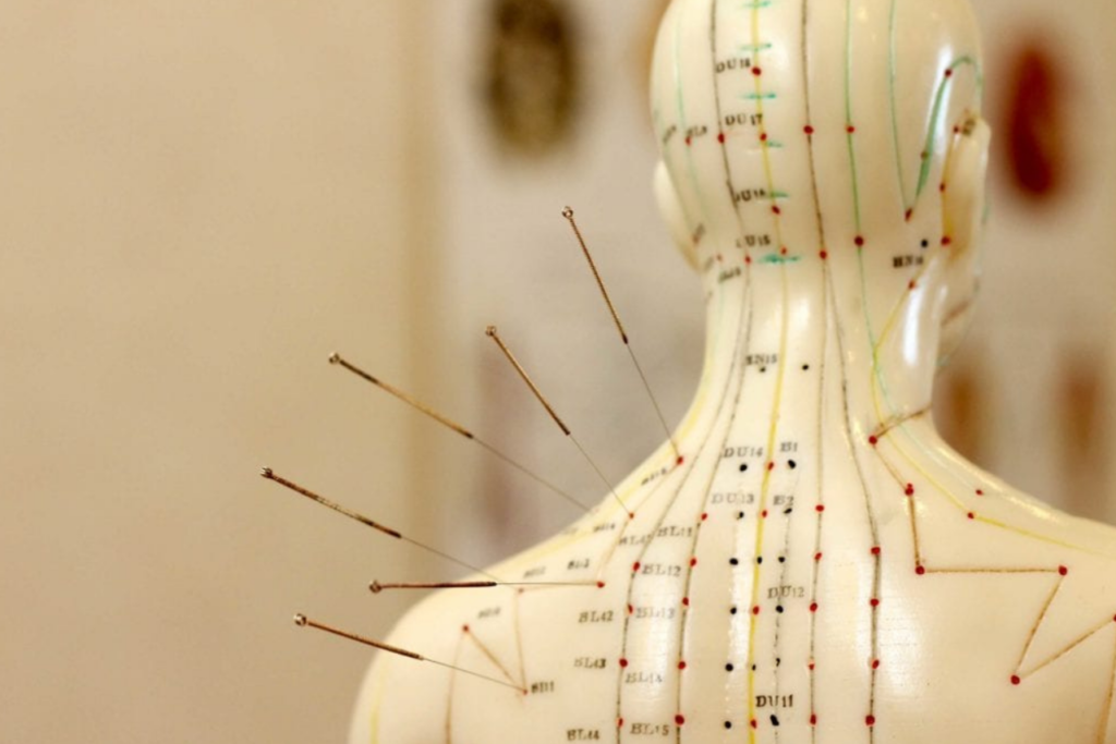 Acupuncture